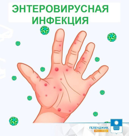 «Внимание, энтеровирусная инфекция! Узнай как не заболеть.» .